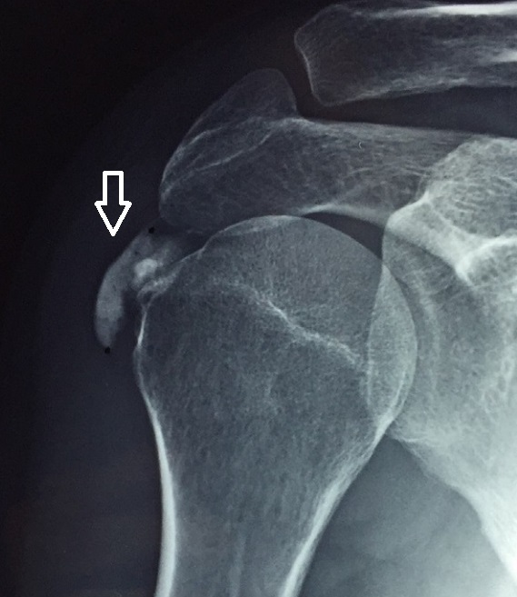 Figure 8. AP radiograph of calcific tendinitis: a calcific deposit at the supraspinatus footprint (arrow). Source: Pakos et al., annotated by Mikael Häggström, via Wikimedia Commons, CC BY 4.0.