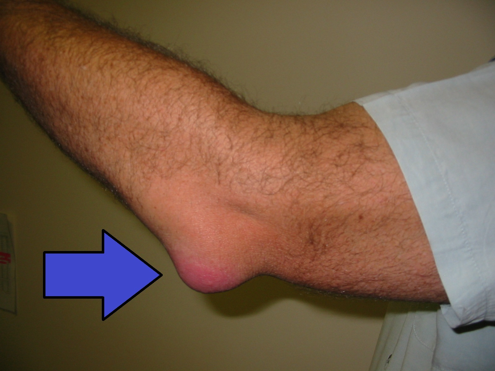 Figure 10. Olecranon bursitis: a fluctuant swelling over the olecranon (arrow). Source: NJC123, via Wikimedia Commons, CC0 1.0 (public domain).
