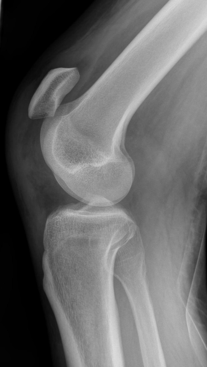Figure 7. Patella alta from a patellar tendon rupture: the patella sits high above the trochlea on the lateral radiograph. Image by Hellerhoff, CC BY-SA 4.0, via Wikimedia Commons.