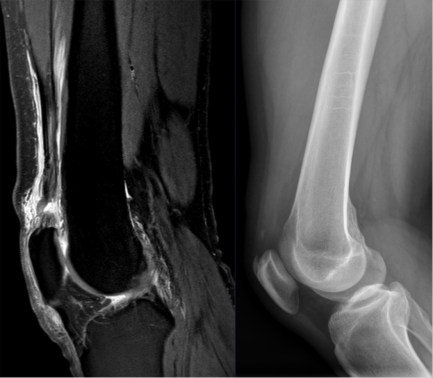 Figure 8. Traumatic quadriceps tendon rupture on sagittal PD-weighted MRI and the lateral radiograph. Image by Hellerhoff, CC BY-SA 4.0, via Wikimedia Commons.