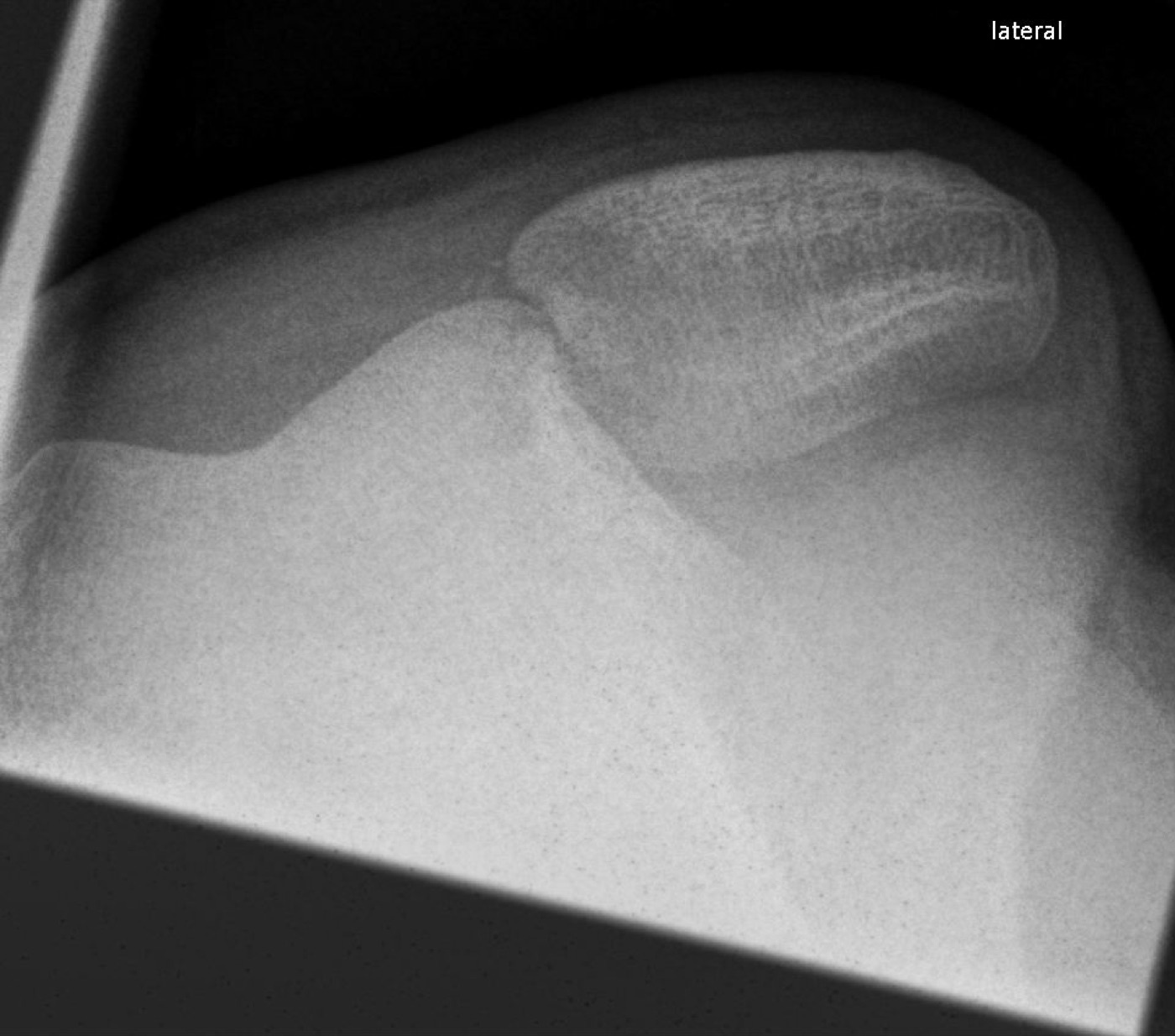 Figure 9. Acute lateral patellar dislocation on the axial (skyline) radiograph, the patella displaced off the trochlea. Image by Hellerhoff, CC BY-SA 3.0, via Wikimedia Commons.