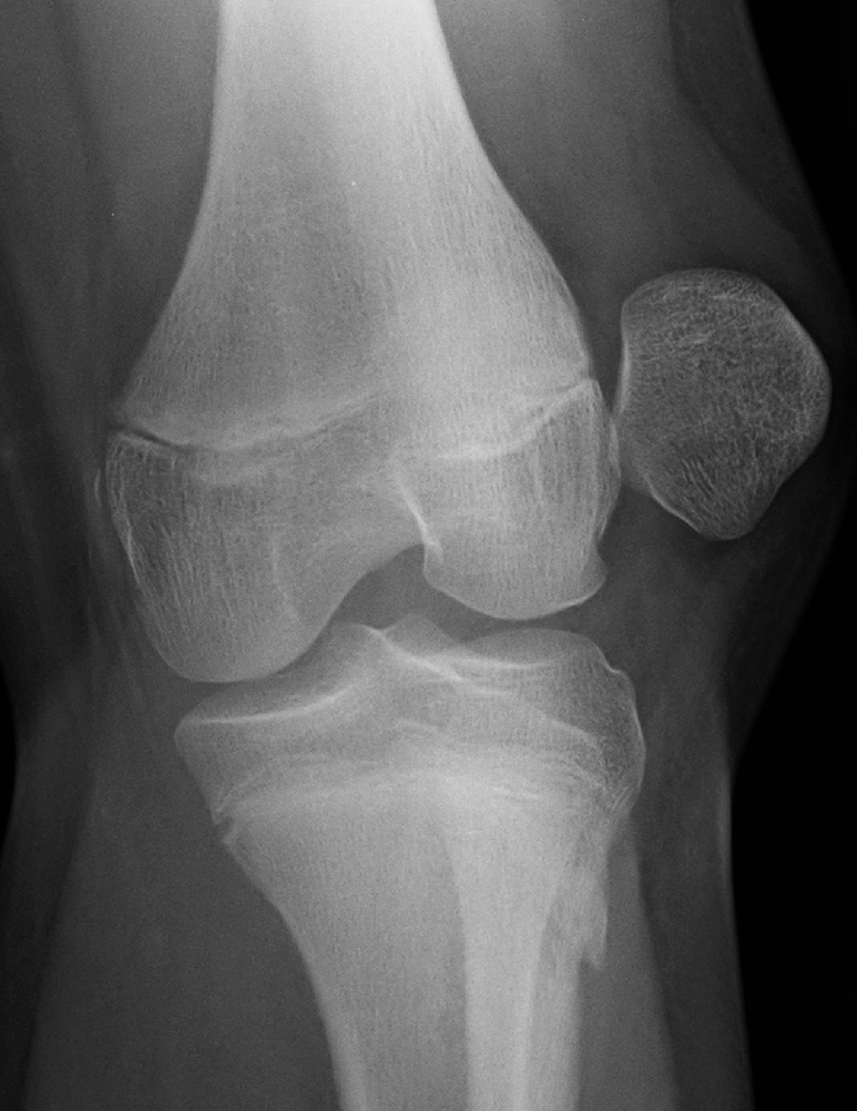 Figure 10. Acute lateral patellar dislocation on the AP radiograph, the patella lying lateral to the femoral condyle. Image by James Heilman, MD, CC BY-SA 4.0, via Wikimedia Commons.