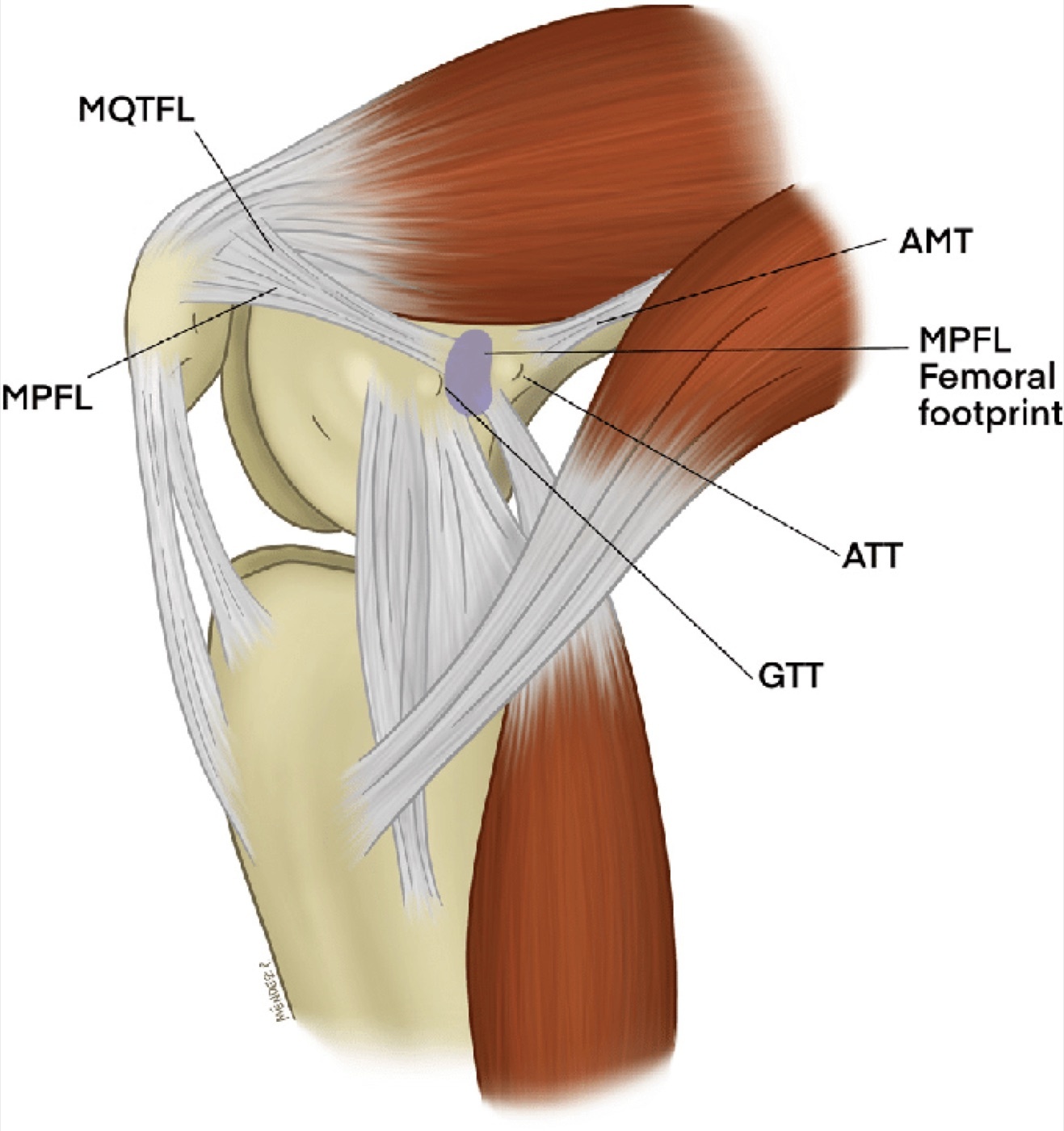 Figure 11. Medial view of a flexed knee showing the medial patellofemoral ligament (MPFL), the main restraint to lateral patellar displacement. Illustration by Negrin et al., CC BY 4.0, via Wikimedia Commons.