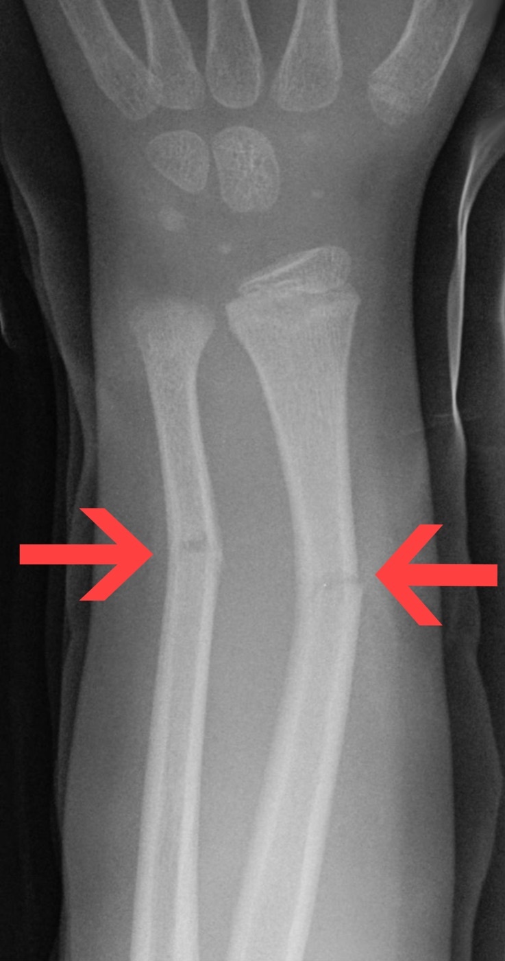 Figure 6. Greenstick fractures of the distal radius and ulna in a child (arrows): the cortex breaks on the convex (tension) side while the concave cortex remains intact. Hellerhoff, CC BY-SA 3.0, via Wikimedia Commons.