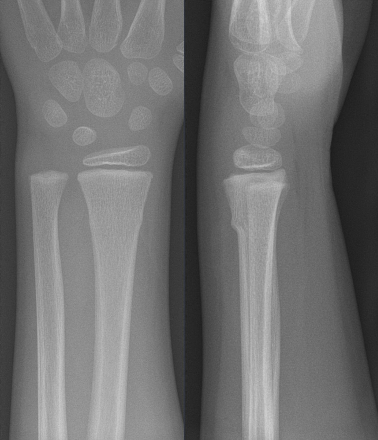 Figure 7. Torus (buckle) fracture of the distal radius in a 6-year-old: cortical buckling of the metaphysis in two planes, with the physis intact. Hellerhoff, CC BY-SA 4.0, via Wikimedia Commons.