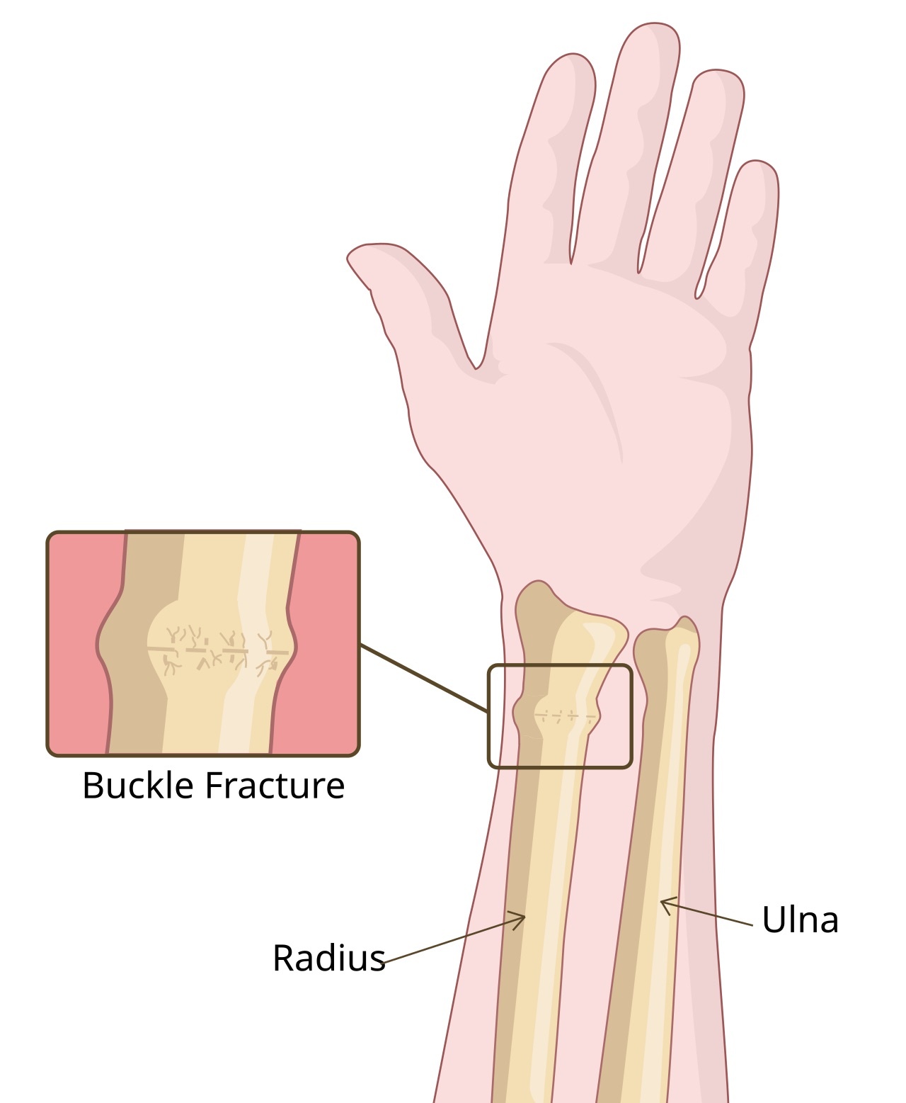 Figure 8. Diagram of a buckle (torus) fracture of the distal radius. RouDhi, CC BY-SA 4.0, via Wikimedia Commons.