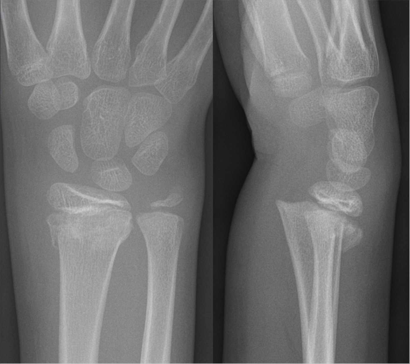 Figure 10. Salter-Harris type II fracture of the distal radius: physeal separation with the triangular metaphyseal (Thurston-Holland) fragment, two planes. Hellerhoff, CC BY-SA 4.0, via Wikimedia Commons.