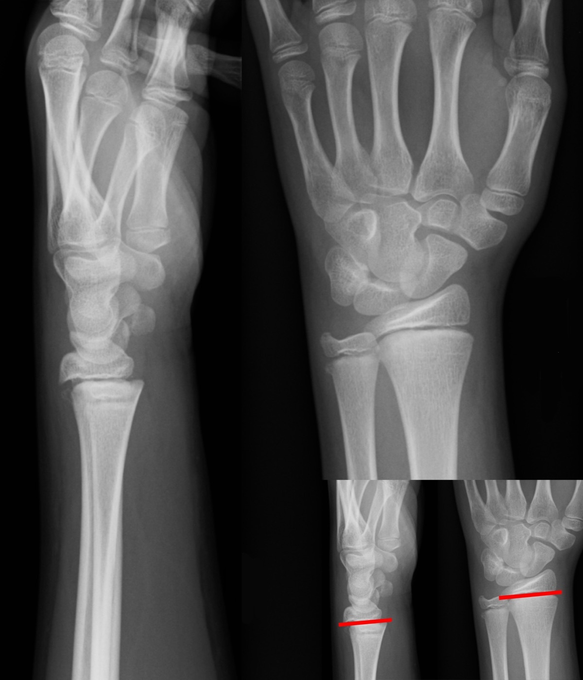Figure 11. Salter-Harris type I physeal injury of the distal radius (lines), a separation straight through the physis with no bony fragment. Gilo1969, CC BY 3.0, via Wikimedia Commons.