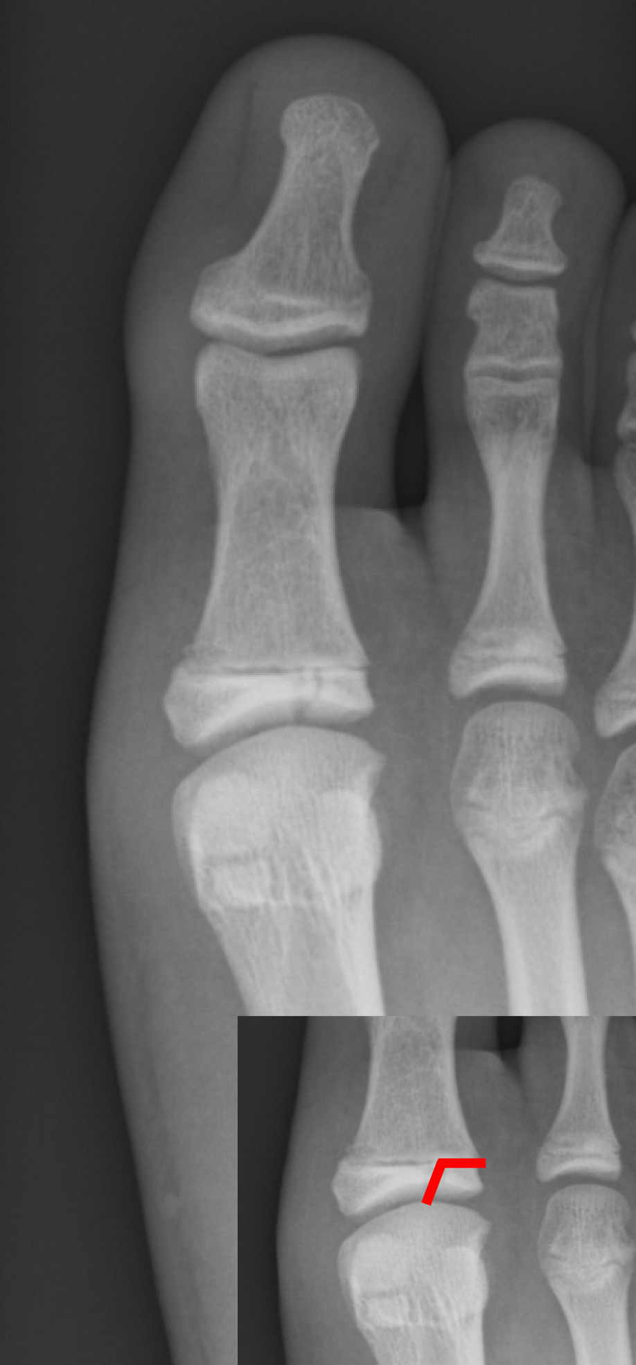 Figure 12. Salter-Harris type III fracture of the great-toe proximal phalanx, the fracture line passing through the physis into the epiphysis and joint. Gilo1969, CC BY 3.0, via Wikimedia Commons.