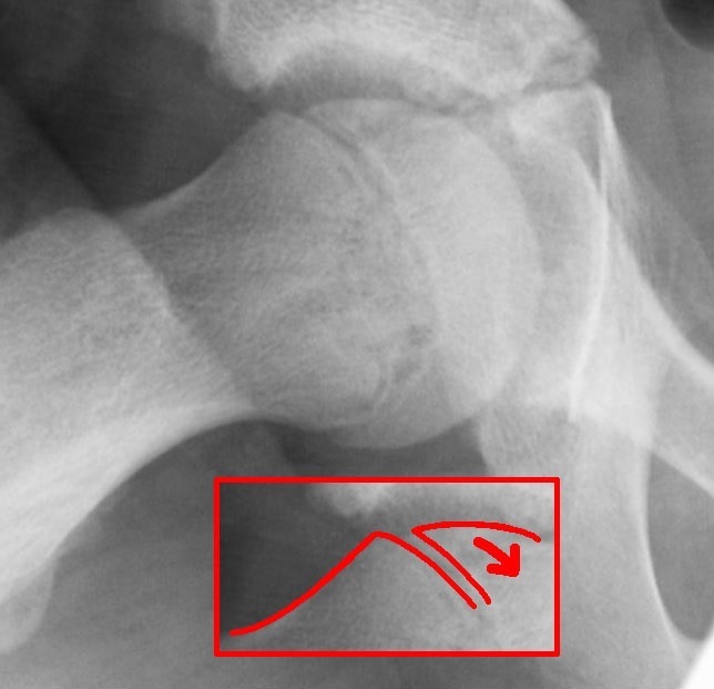 Figure 13. Slipped capital femoral epiphysis, a Salter-Harris type I-equivalent slip through the proximal femoral physis. Dr. Jochen Lengerke, CC0, via Wikimedia Commons.