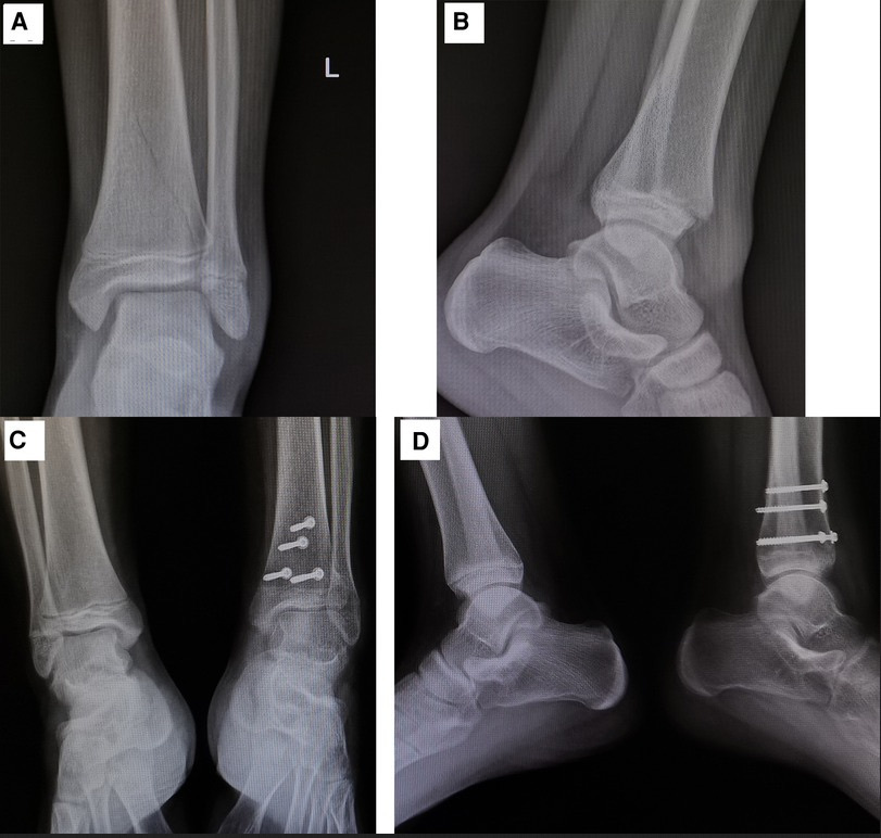Figure 14. Premature physeal closure (growth arrest) of the distal tibia after a physeal fracture: the injured physis closes while the contralateral physis stays open. Wang et al., CC BY 4.0, via Wikimedia Commons.