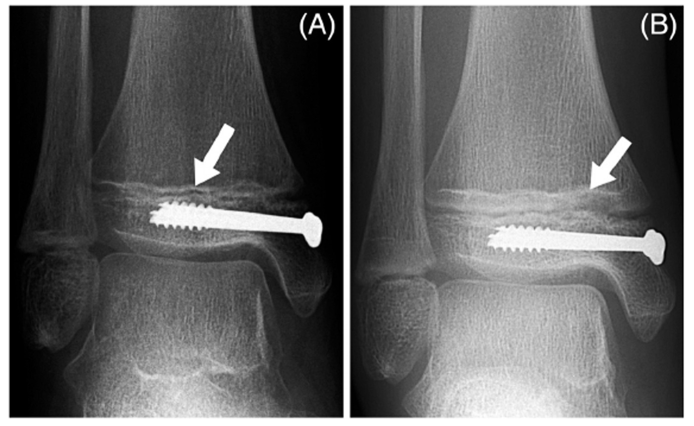 Figure 15. A Park-Harris growth-arrest line (arrows) that has grown away parallel to the distal tibial physis between two and seven months, indicating continued symmetric growth. Kennedy et al., CC BY 2.0, via Wikimedia Commons.