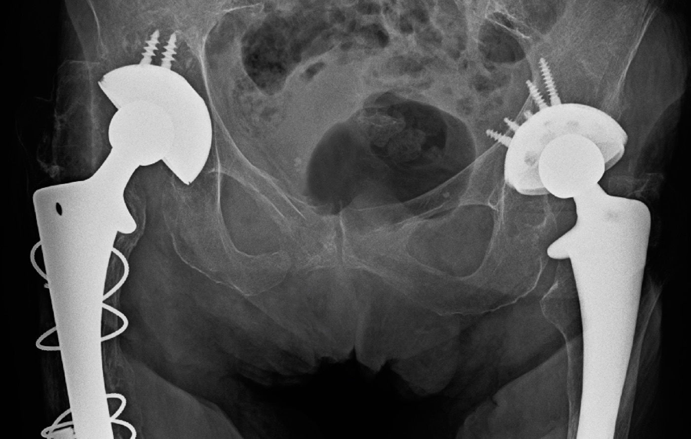 Figure 3. Fractures of the superior and inferior pubic rami on an AP pelvis radiograph, the anterior half of a ring injury. James Heilman, MD, CC BY-SA 4.0, via Wikimedia Commons.