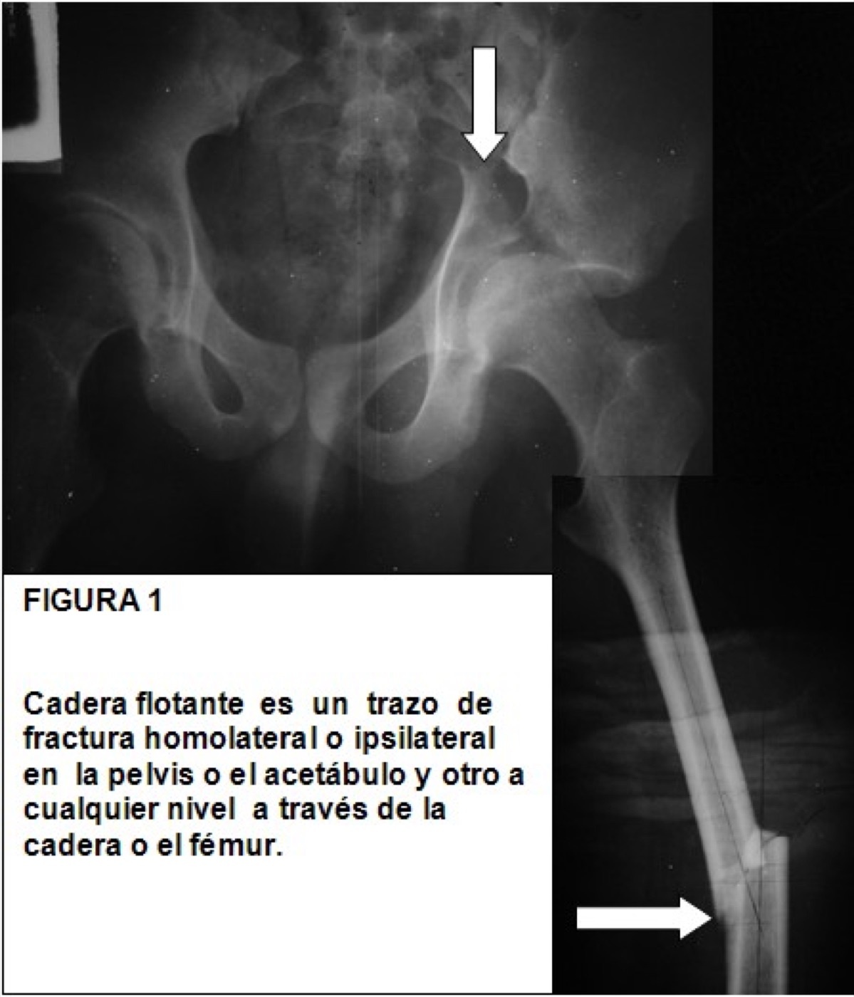 Figure 4. A displaced, unstable ipsilateral pelvic and femoral injury (a floating-hip injury), illustrating the high-energy displaced pattern. DrMedina, CC BY-SA 3.0, via Wikimedia Commons.