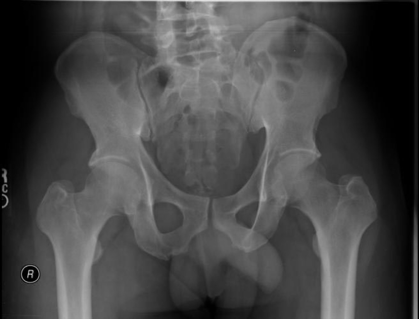 Figure 5. A normal AP pelvis radiograph for comparison, the first and most useful study in the injured patient. RadsWiki, CC BY-SA 3.0, via Wikimedia Commons.