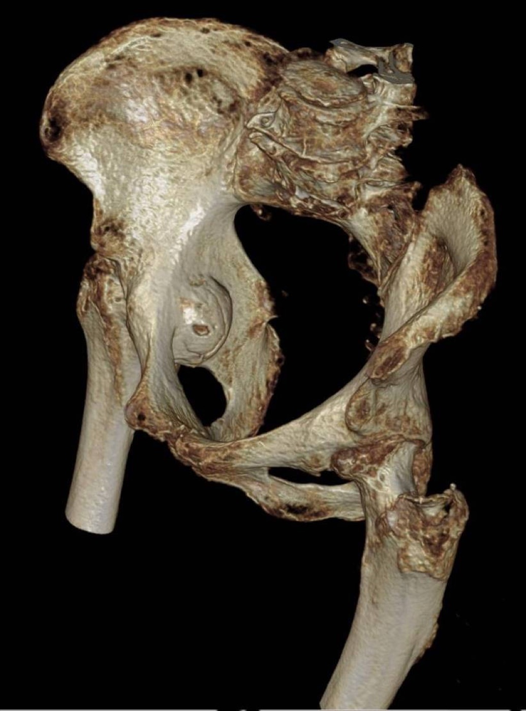 Figure 6. A 3D CT volume rendering of a pelvic and acetabular injury, the kind of reconstruction CT adds to the plain films. Hellerhoff, CC BY-SA 4.0, via Wikimedia Commons.