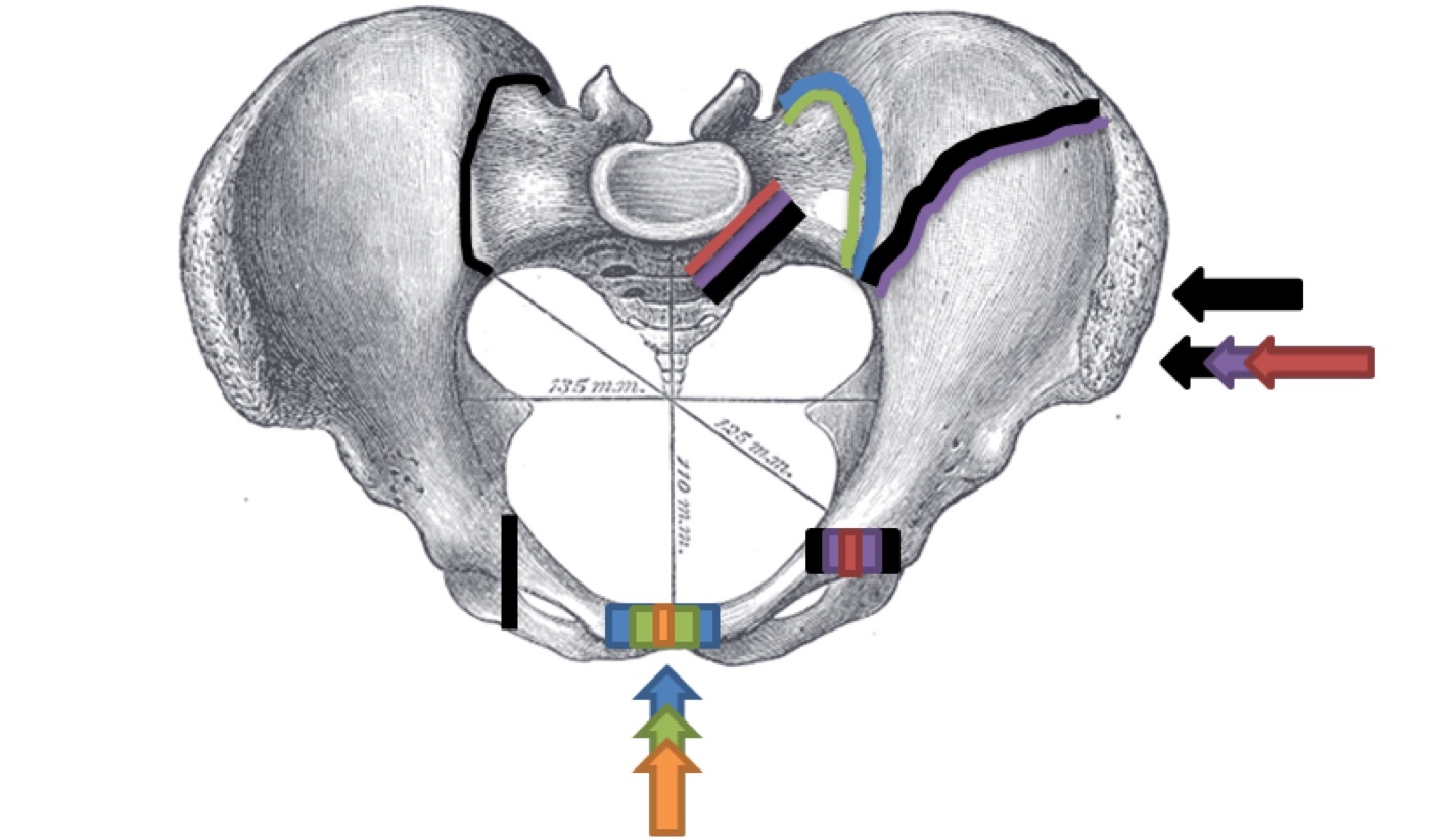 Figure 7. The Young-Burgess mechanisms of pelvic-ring injury (schematic): anteroposterior compression, lateral compression, and vertical shear. Annotation by Kinanat0212 on a Gray’s Anatomy (1918) plate, public domain, via Wikimedia Commons.