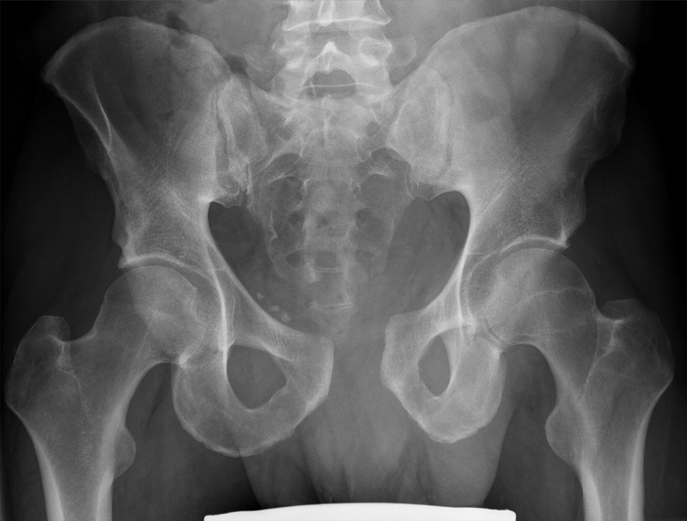 Figure 9. An open-book injury with symphyseal disruption and widening of the sacroiliac joint, the combined anterior and posterior APC disruption. Hellerhoff, CC BY-SA 4.0, via Wikimedia Commons.