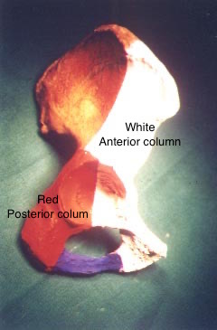 Figure 5. The two acetabular columns on a hip-bone model: anterior (iliopubic) column in white, posterior (ilioischial) column in red. Dr. C. J. Thakkar, CC BY-SA 4.0, via Wikimedia Commons.