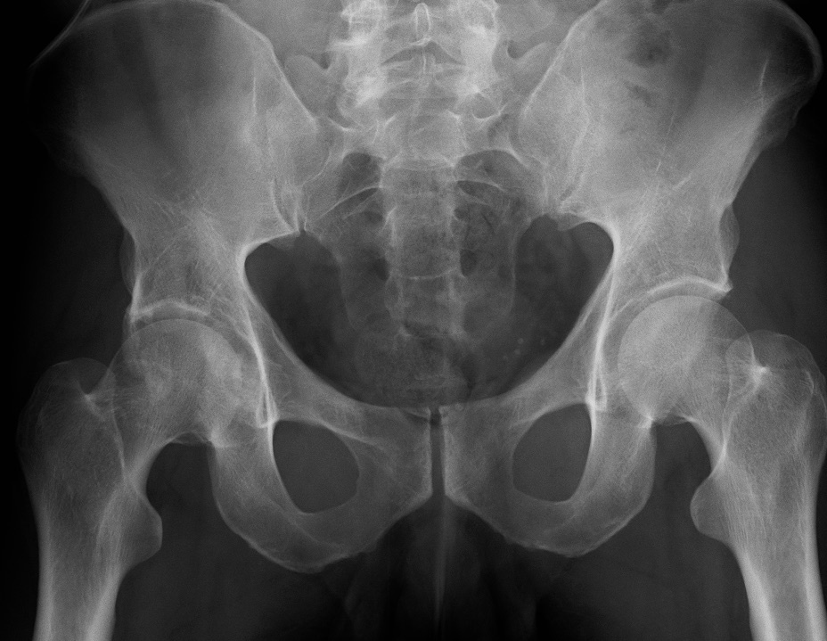 Figure 7. AP pelvic radiograph of a right acetabular fracture. James Heilman MD, CC BY-SA 4.0, via Wikimedia Commons.