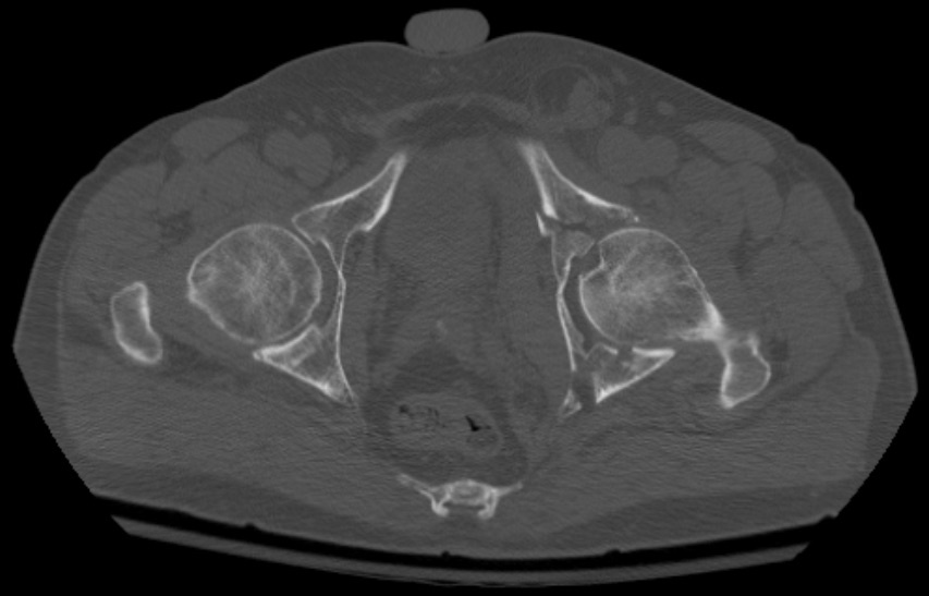 Figure 8. Axial CT (bone window) of a comminuted both-column acetabular fracture. Seannovak, CC BY-SA 3.0, via Wikimedia Commons.