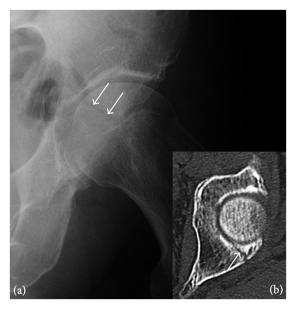 Figure 9. Subtle posterior acetabular wall fracture on radiograph (arrows) with corresponding CT. Jarraya et al., Radiol Res Pract 2013, CC BY 3.0, via Wikimedia Commons.