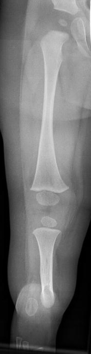 Antero-posterior radiograph of the lower leg in an 18-month-old child with fibular hemimelia: the tibia is present while the fibula is short and hypoplastic (Achterman-Kalamchi type II pattern). (Kinderradiologie Olgahospital, Klinikum Stuttgart, Wikimedia Commons, CC BY-SA 4.0.)