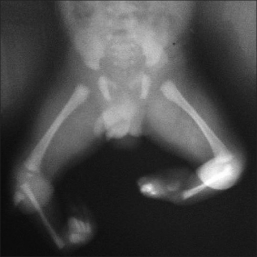 Babygram of the lower limbs in bilateral tibial hemimelia: the hips and distal femora are present, both tibiae are absent (only a small cartilaginous anlage), the fibula is present on each side, and the feet are deformed. (Chinnakkannan et al., Indian J Hum Genet 2013;19:108, Fig. 3; CC BY-NC-SA - non-commercial use only.)