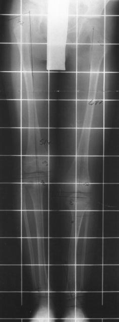 Standing antero-posterior radiograph of the lower legs (with a measurement grid) in congenital posteromedial bowing of the tibia: tibial bowing and a length discrepancy. (Kaufman et al., Strategies Trauma Limb Reconstr 2012;7:147, Fig. 1; CC BY.)
