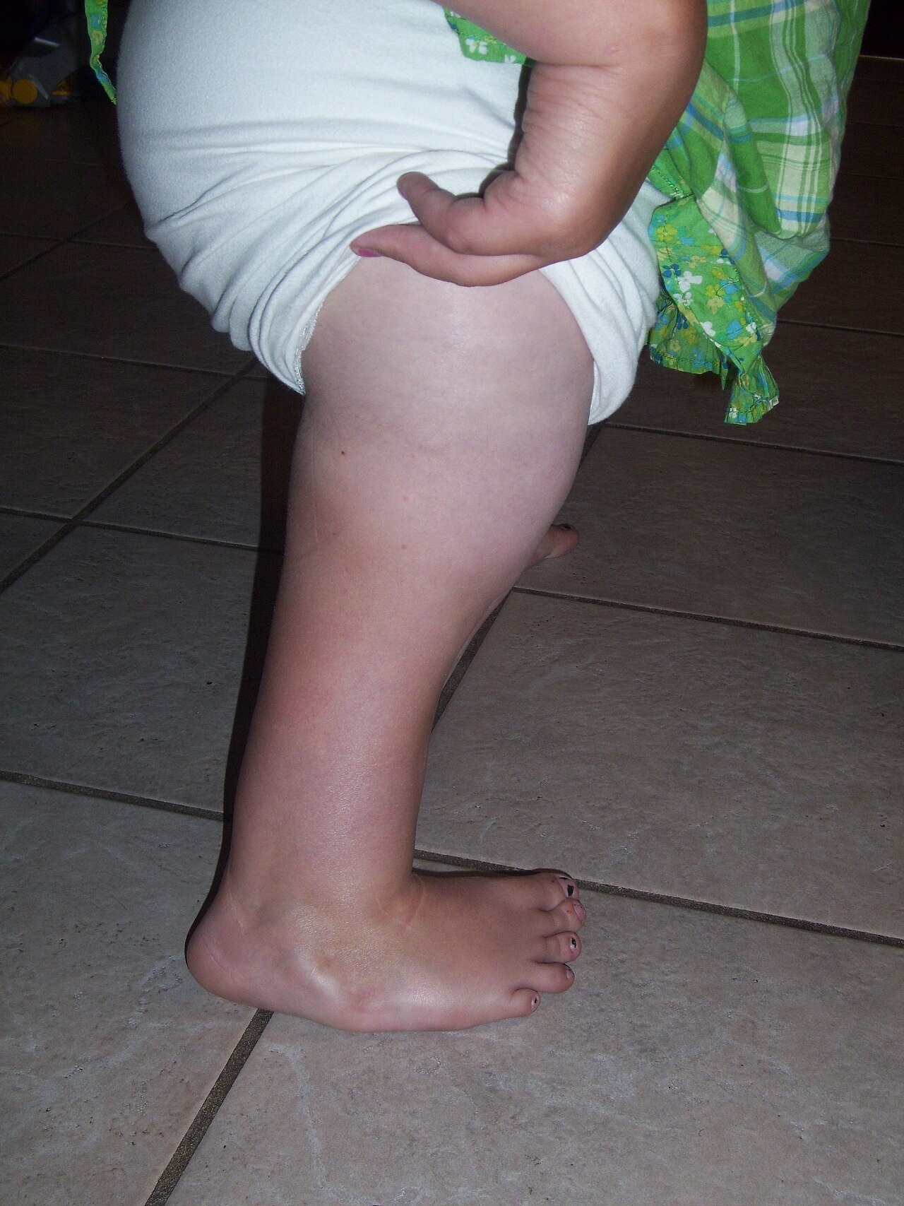Clinical appearance of congenital femoral deficiency: a markedly short lower limb. In the severe form the thigh segment is short and bulbous and the foot of the affected side sits at the level of the opposite knee. (Wikimedia Commons, “Doughty74”, CC BY-SA 3.0.)