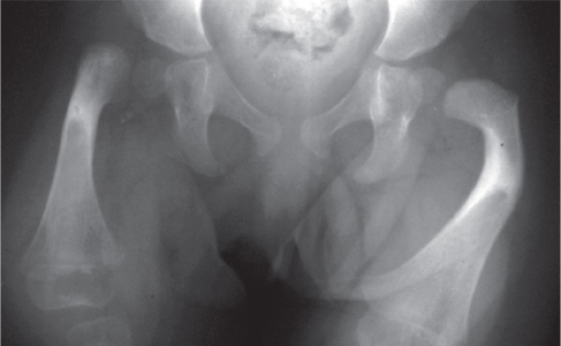 Antero-posterior radiograph of both hips in an infant with congenital femoral deficiency: the proximal femur on the affected side is short and deficient compared with the normal contralateral hip. (Simpson-White et al., Acta Orthop 2013;84:323, Fig. 1; CC BY.)