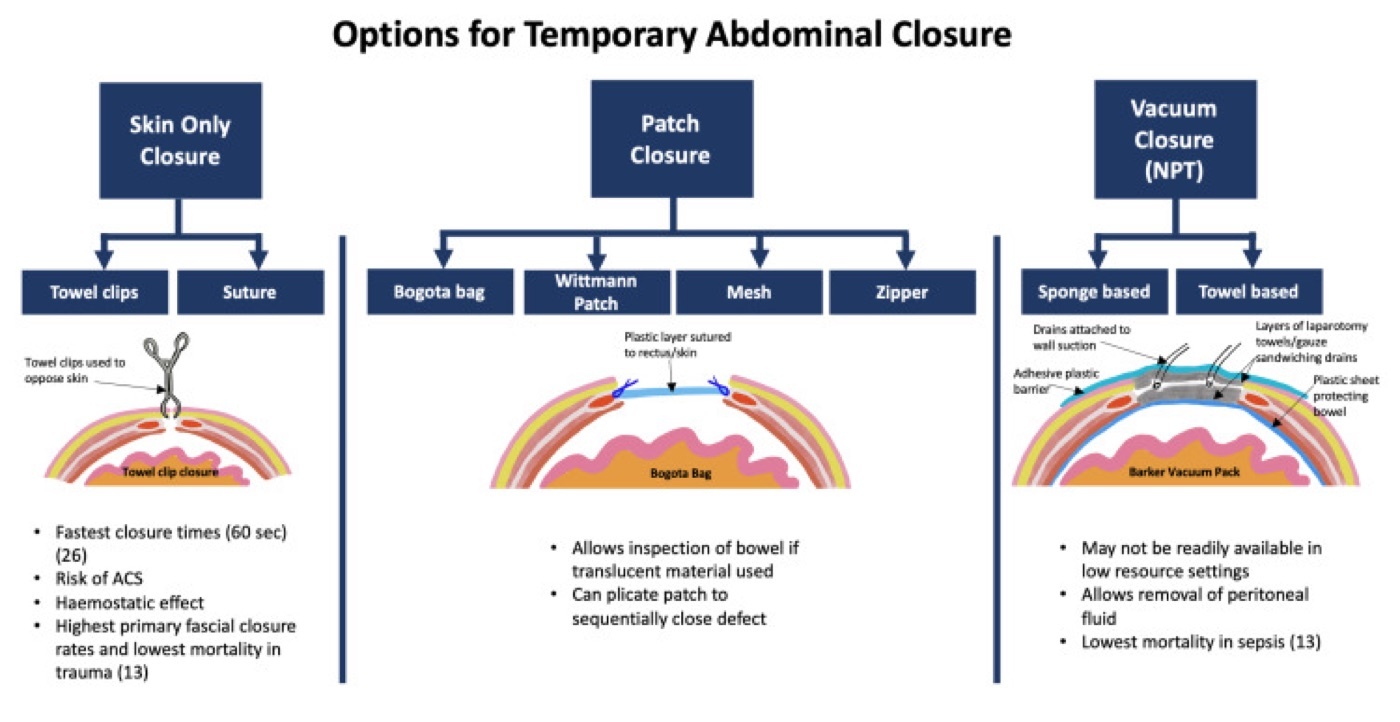 Figure 11. Temporary abdominal closure options for the open abdomen in damage-control surgery (skin-only, patch/Bogotá-bag, and negative-pressure techniques). Source: Milne et al., Cureus 2021;13:e15489, CC BY 3.0.