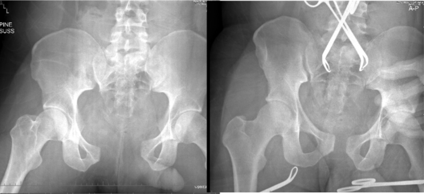 Figure 13. An unstable pelvic ring before (left) and after (right) application of a pelvic circumferential compression binder, reducing the pelvic volume. Source: Vaidya et al., West J Emerg Med 2016;17:766, CC BY 4.0.