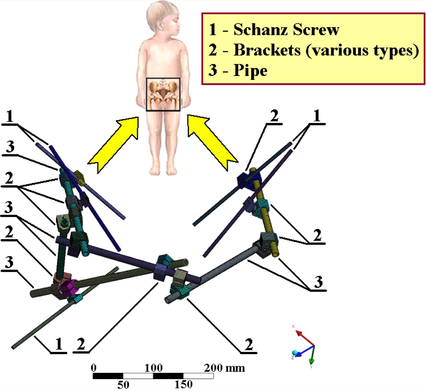 Figure 14. An anterior pelvic external fixator (Schanz screws and connecting frame) for definitive damage control of the pelvic ring. Source: Karel Frydryšek (Fry72), via Wikimedia Commons, CC BY-SA 4.0.