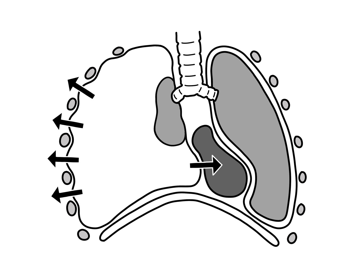 Figure 2. Tension pneumothorax: the collapsed lung and mediastinal shift that must be found and decompressed during the “B” of the primary survey. Source: Baedr-9439, via Wikimedia Commons, CC0 (public domain).