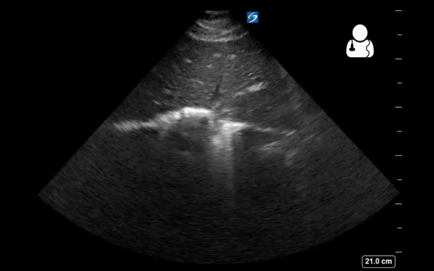 Figure 3. Focused Assessment with Sonography for Trauma (FAST), a bedside adjunct to the primary survey for free intraperitoneal or pericardial blood. Source: Ben Smith / Ultrasound of the Week, via Wikimedia Commons, CC BY-SA 4.0.