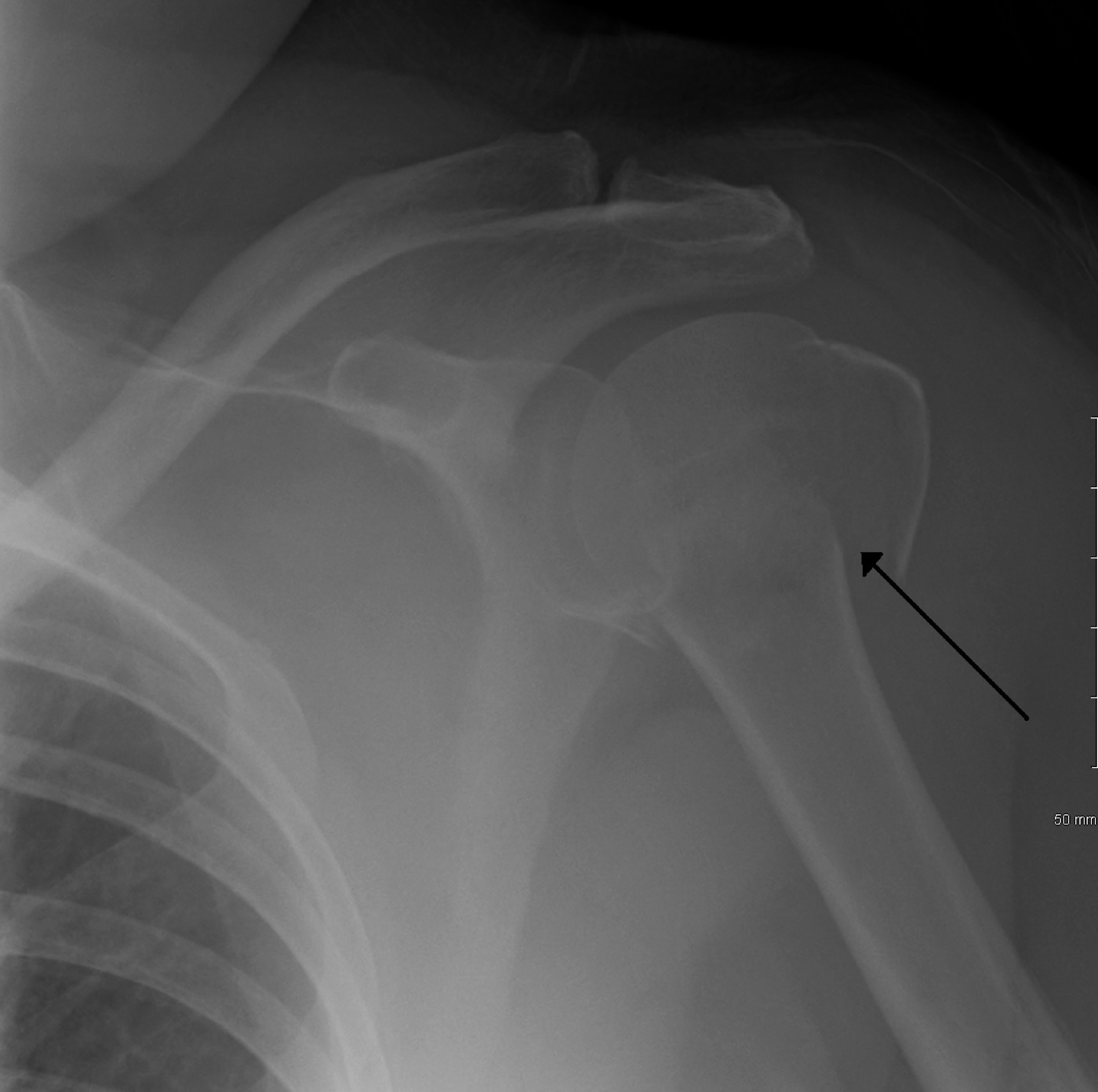 Figure 11. AP radiograph of a displaced proximal humeral fracture. Source: James Heilman, MD, via Wikimedia Commons, CC BY-SA 3.0.