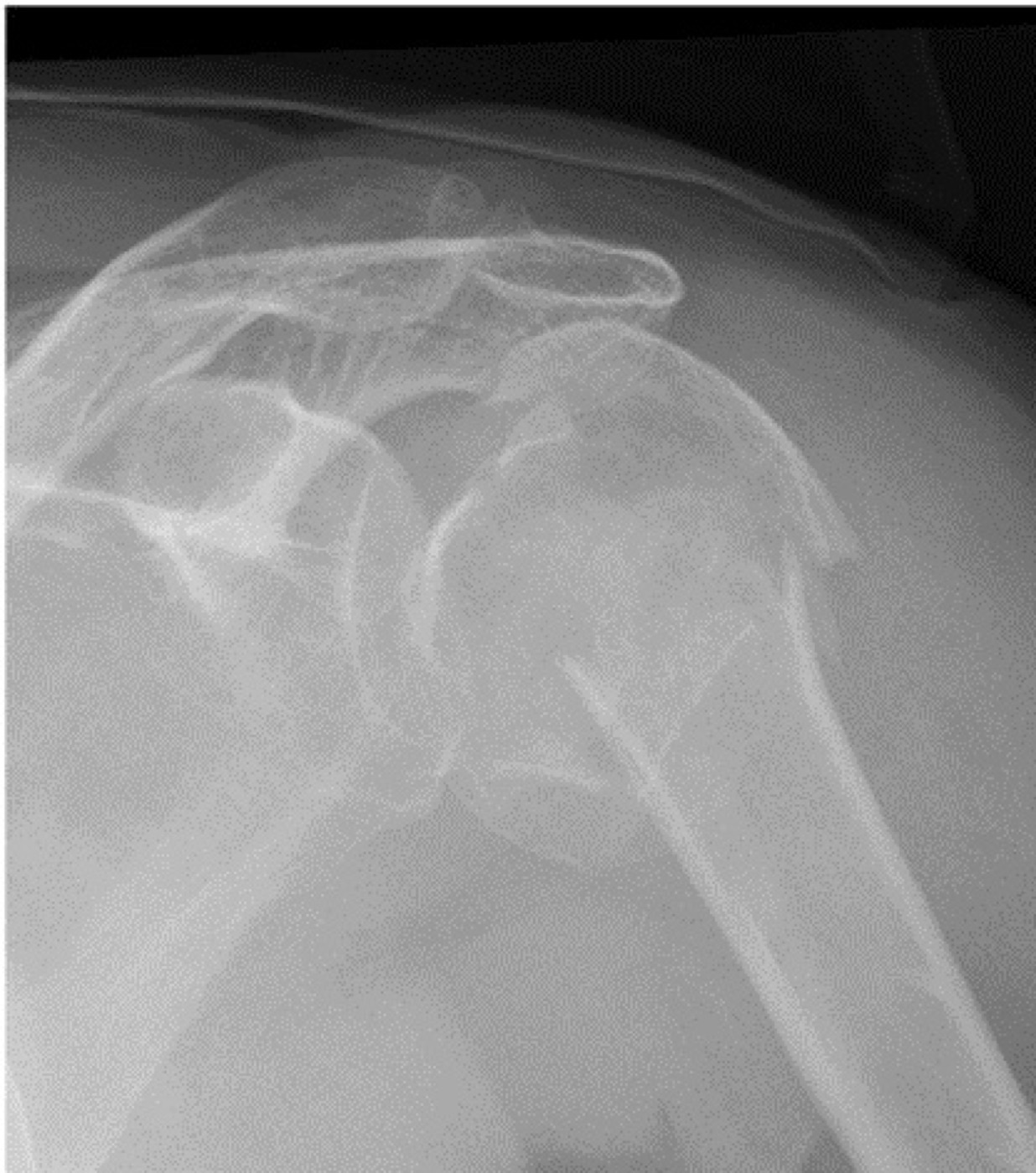 Figure 12. A complex, multifragmentary (three- to four-part) proximal humeral fracture. From Mattiassich et al. (2013), BMC Musculoskeletal Disorders, CC BY 2.0, via Wikimedia Commons.