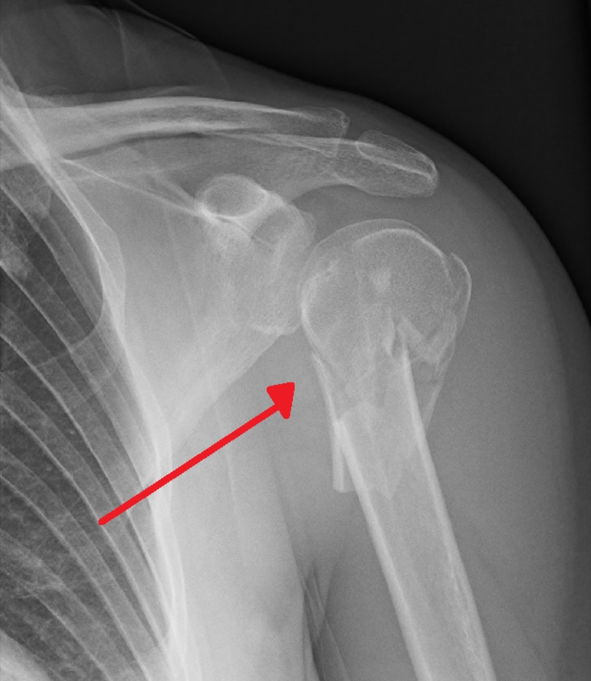 Figure 13. Proximal humeral fracture involving the greater tuberosity; displacement beyond threshold causes subacromial impingement and weakness. Source: James Heilman, MD, via Wikimedia Commons, CC BY-SA 4.0.