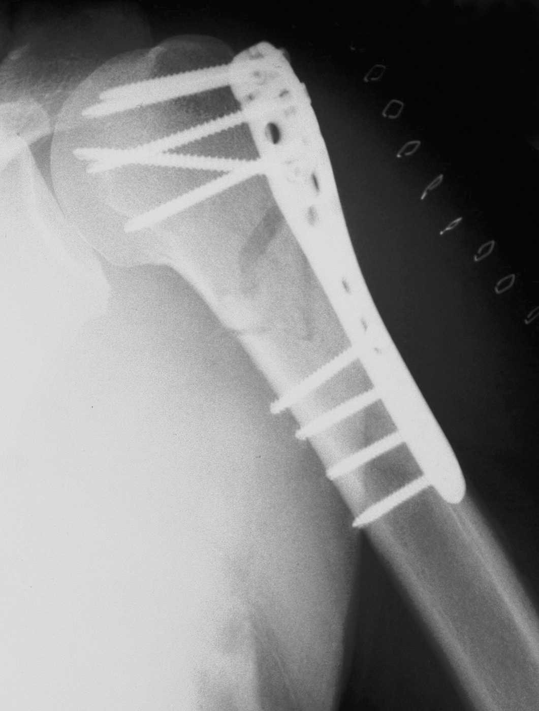 Figure 15. The same locking-plate fixation, lateral view. Source: Thomas Zimmermann (THWZ), via Wikimedia Commons, CC BY-SA 3.0 DE.