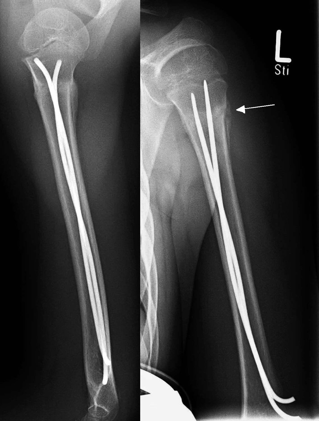 Figure 16. Proximal humeral fracture treated by intramedullary nailing, healed with callus. Source: Thomas Zimmermann (THWZ), via Wikimedia Commons, CC BY-SA 3.0 DE.