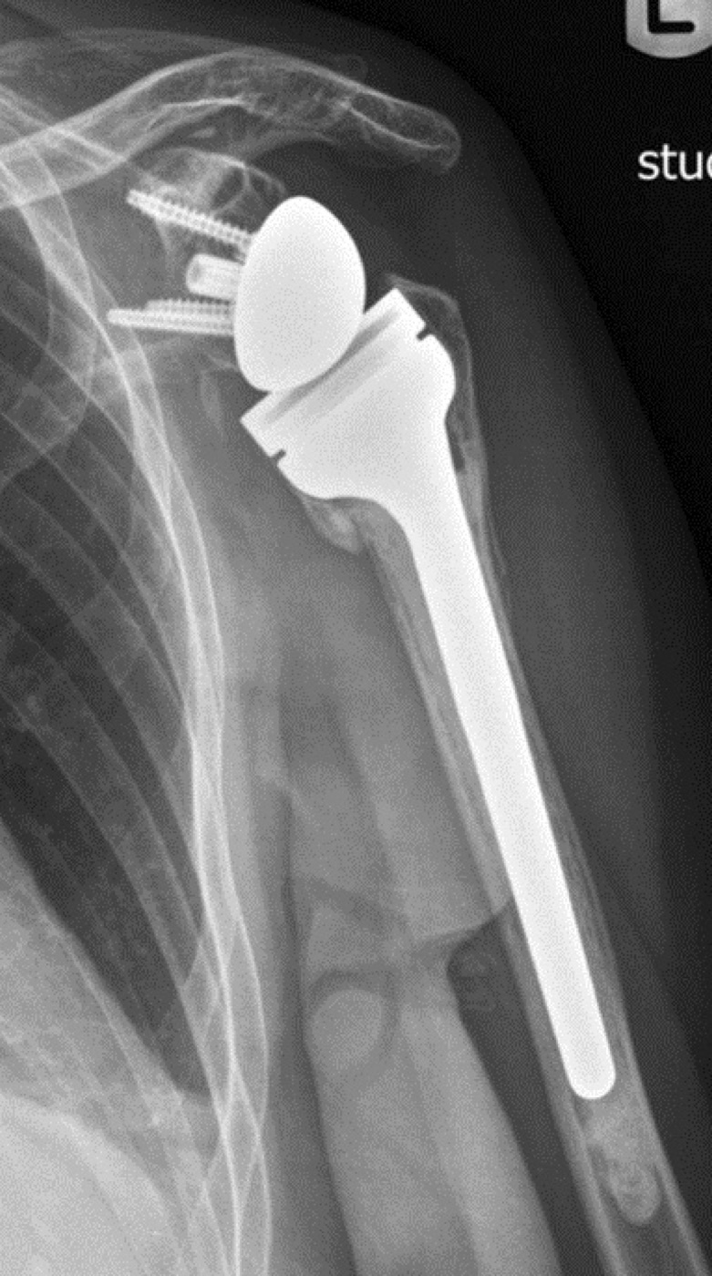 Figure 17. Reverse total shoulder arthroplasty for a comminuted proximal humeral fracture, one year after surgery with a healed greater tuberosity. From Mattiassich et al. (2013), BMC Musculoskeletal Disorders, CC BY 2.0, via Wikimedia Commons.