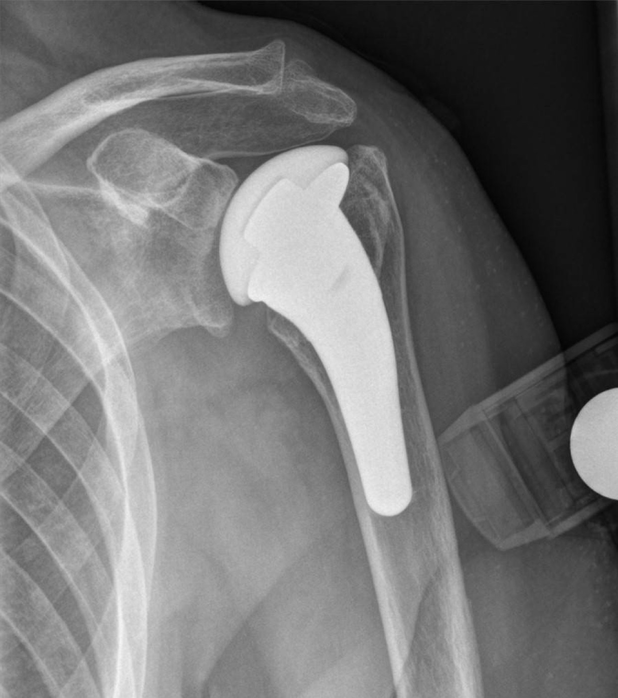 Figure 18. Hemiarthroplasty (humeral head replacement) for fracture, with the native glenoid preserved; its outcome depends on tuberosity healing. Source: Hellerhoff, via Wikimedia Commons, CC BY-SA 4.0.