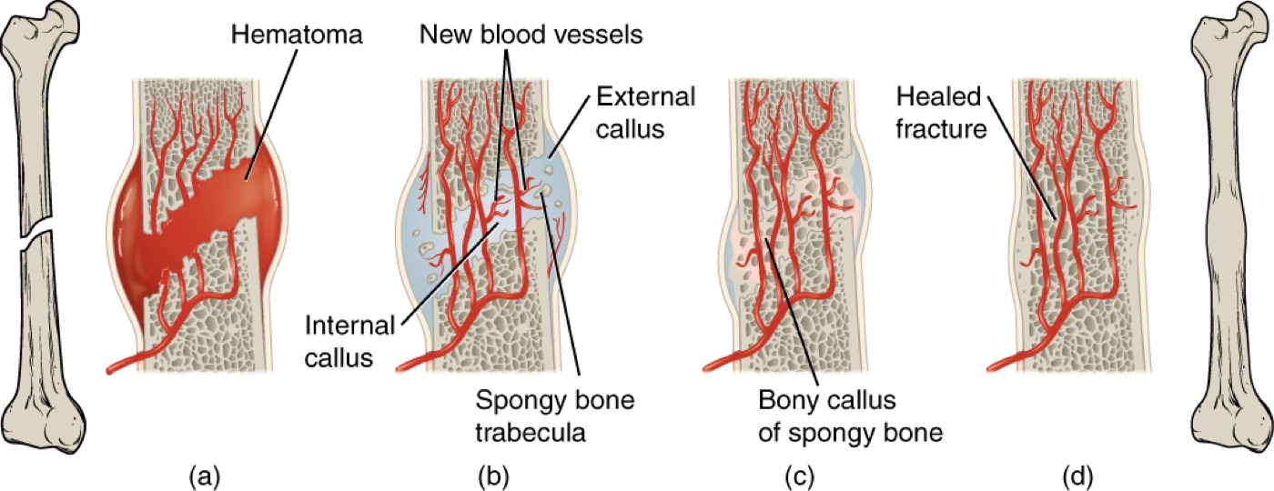 Figure 1. The stages of secondary (callus) bone healing: (a) fracture haematoma, (b) soft then hard callus, (c) bony callus, (d) remodelled bone. Source: OpenStax College, CC BY 3.0, via Wikimedia Commons.