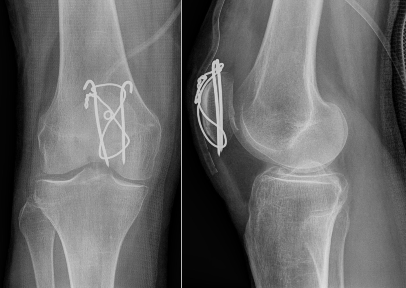 Figure 6. Tension-band wiring of a transverse patellar fracture: parallel K-wires and a figure-of-eight cerclage convert the tensile pull into compression across the fracture on flexion. Source: Hellerhoff, via Wikimedia Commons, CC BY-SA 3.0.