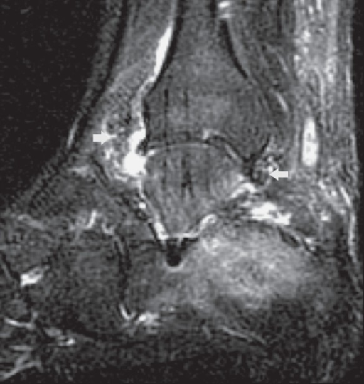 Figure 11. Tuberculous arthritis of the ankle - effusion and synovitis (fat-saturated T2 MRI). De Backer et al., 2009, CC BY, via PMC.