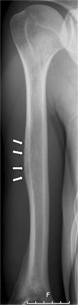 Figure 1. Acute osteomyelitis of the humeral diaphysis (radiograph). Prodinger et al., BMC Infect Dis 2013, CC BY 2.0, via PMC.