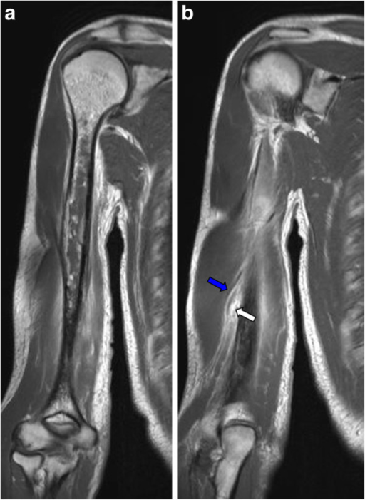 Figure 2. The same humerus on contrast MRI - marrow change is evident far earlier than on the radiograph. Prodinger et al., 2013, CC BY 2.0, via PMC.
