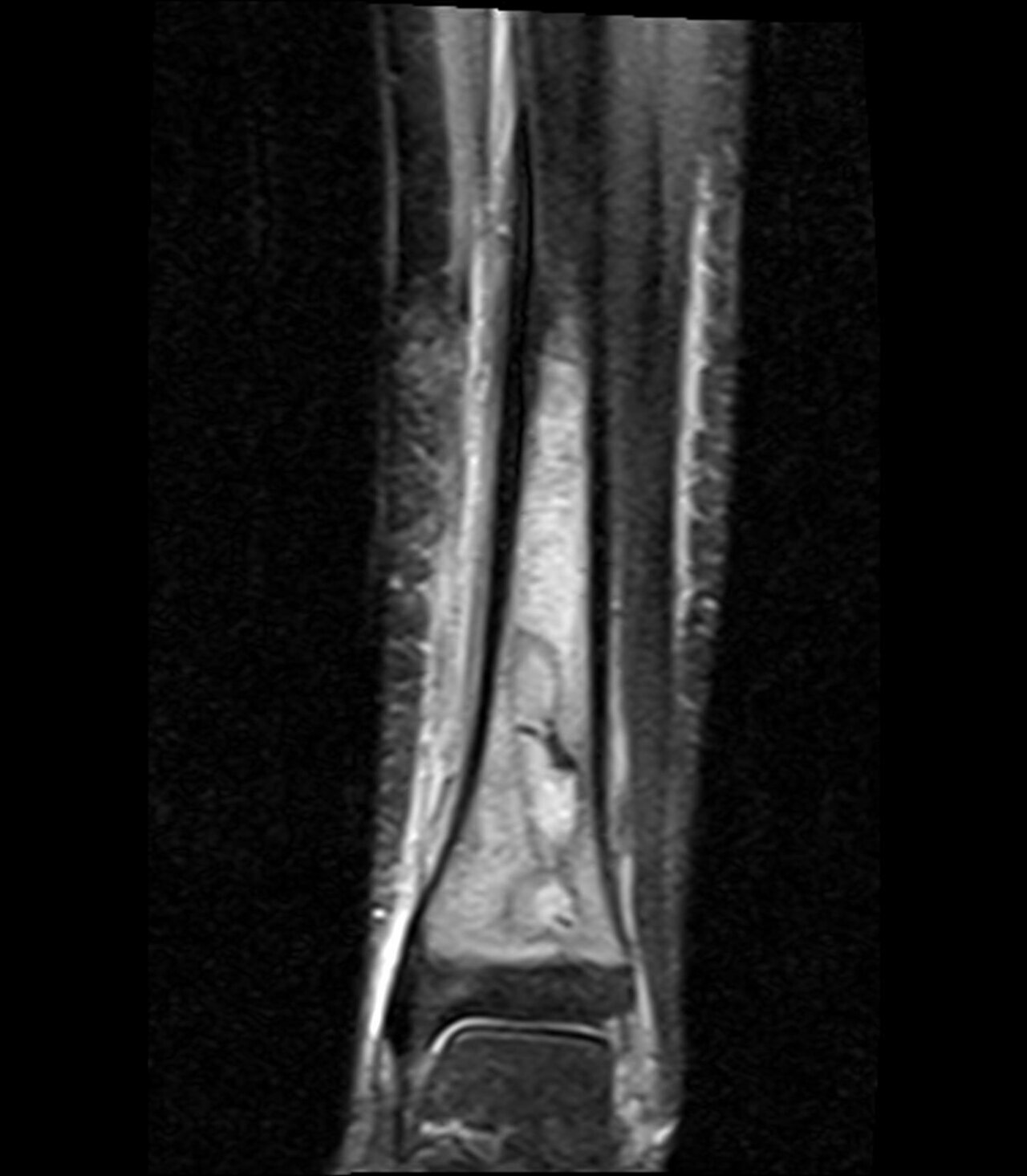 Figure 5. Brodie abscess - fluid-filled cavity on coronal STIR MRI. Jto410, CC BY-SA 3.0, Wikimedia Commons.