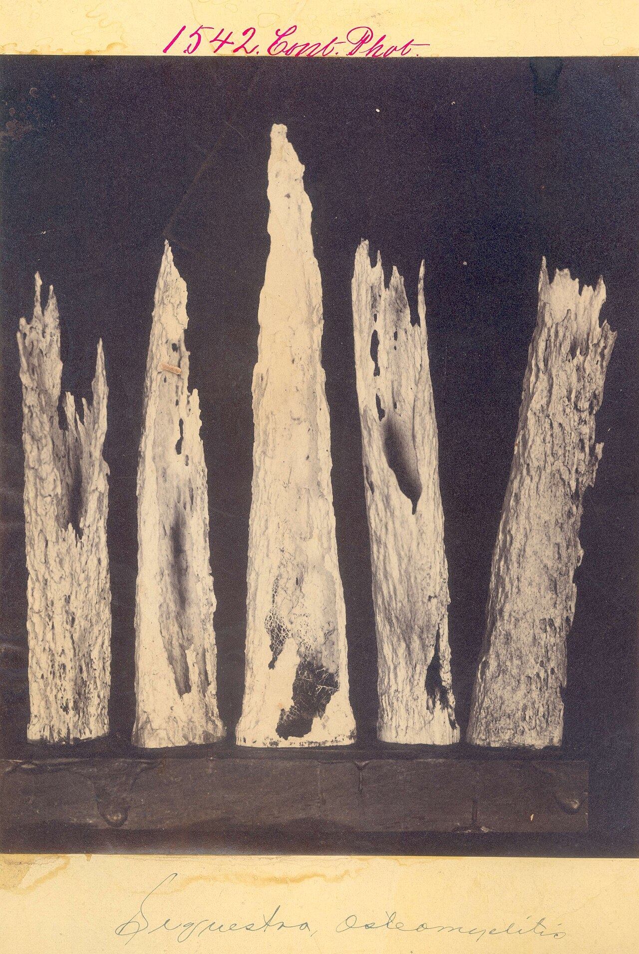 Figure 6. Chronic osteomyelitis - bony sequestra (necrotic, biofilm-colonised fragments). Otis Historical Archives, NMHM, CC BY 2.0, via Wikimedia Commons.